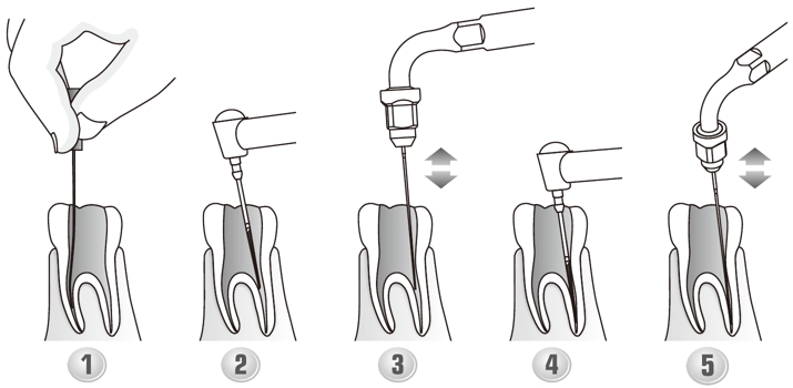 Сфера применения наконечника для скалера